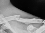 Emil Johansson injury Cairns 2025